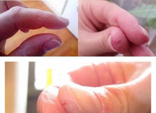 الجلد الخشن على اليدين الجلد الميت على الأصابع